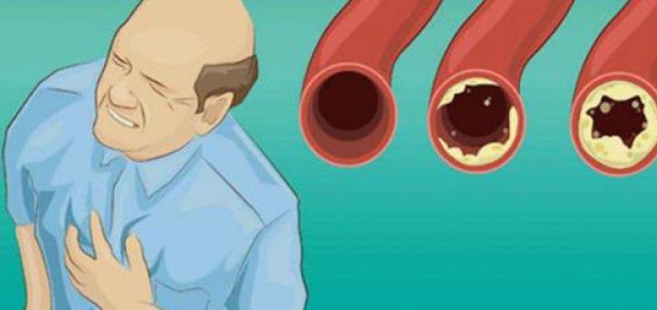 12 ushqimet që duhet të hani çdo ditë për të pastruar arteriet