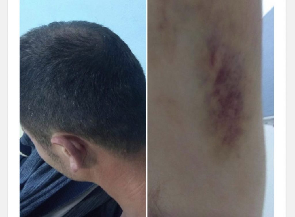FOTO/ “Më rrahën barbarisht dhe më tërhoqën zvarrë për 20 m”- pedagogu denoncon tek Berisha dhunën në komisariat