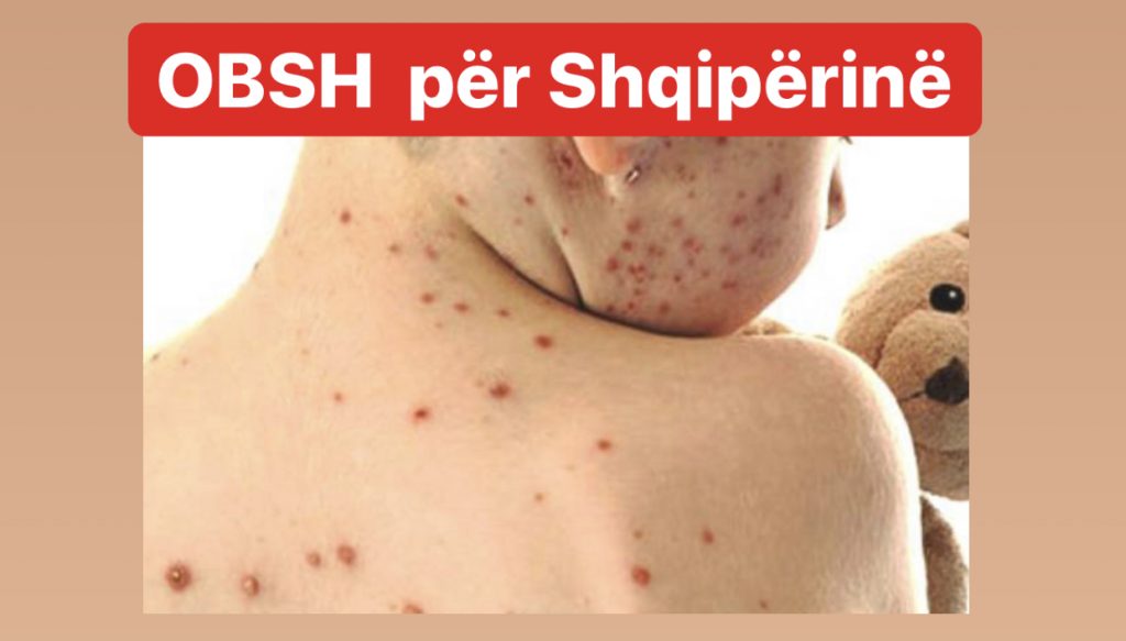 Alarmi/ Në Shqipëri   po përhapet fruthi