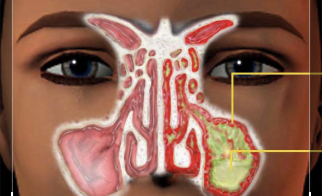Humbja e nuhatjes nga COVID-19/Çfarë është anosmia?