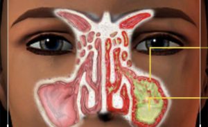 Humbja e nuhatjes nga COVID-19/Çfarë është anosmia?