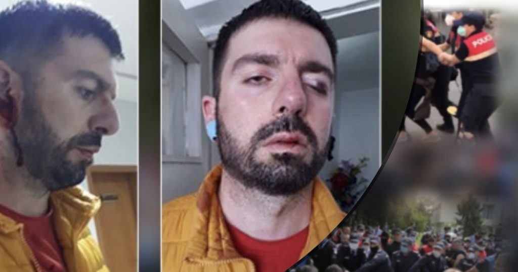 I përgjakur dhe me fraktura, pasojat e dhunës policore mbi djalin e gazetares
