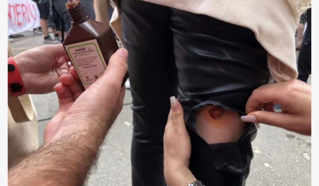 Shikoni vajzën e lënduar nga shashkat që u hodhën në protestë, e mjekojnë me betadinë