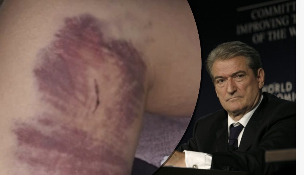 Denoncimi me FOTO : Policia rreh në furgon protestuesin. I mituri: Kam 3 ditë nuk lëviz dot, më kishte plasur gjaku