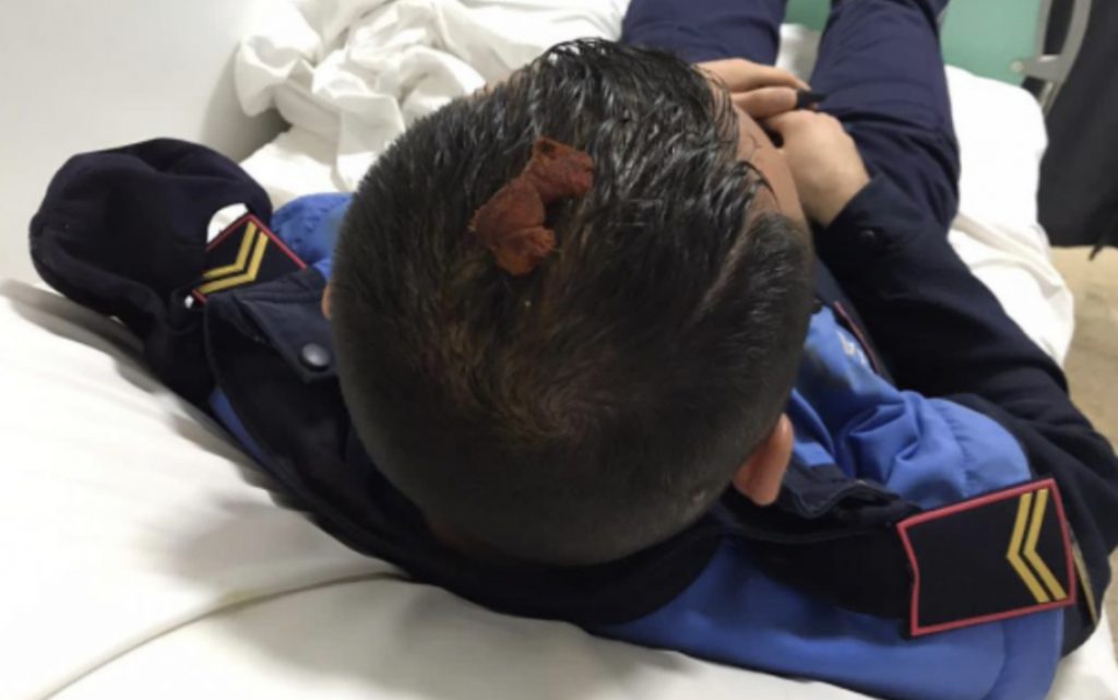 Djegie, plagë në kokë, sy e gjymtyrë te Trauma, dalin pamjet e policëve të dëmtuar në protestë