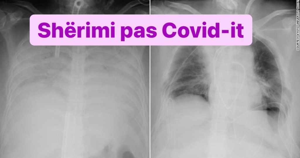Shpërthimi i Omicron dhe virozat e stinës, mjekja pneumologe: Brenda ditësh infektohet e gjithë familja