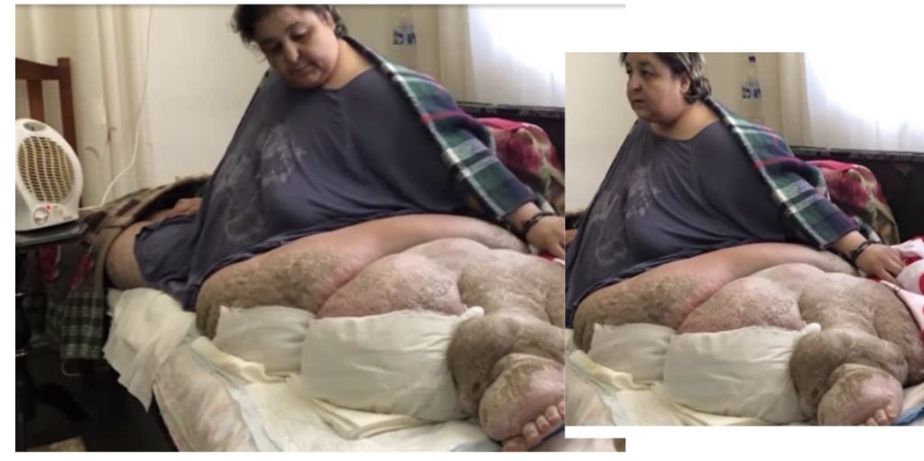 FOTOT/ Vajza nga Vlora vuan nga sëmundja e elefantizmit sot peshon 450 kg