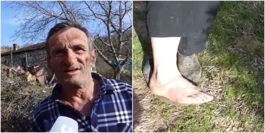 Shpërtheu granata kur po punonin me bel/ Kasemi tregon plagën në këmbë