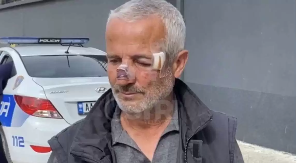 ‘Gjej 10 vota për PS-në’/ Dhunohet barbarisht punonjësi i bashkisë