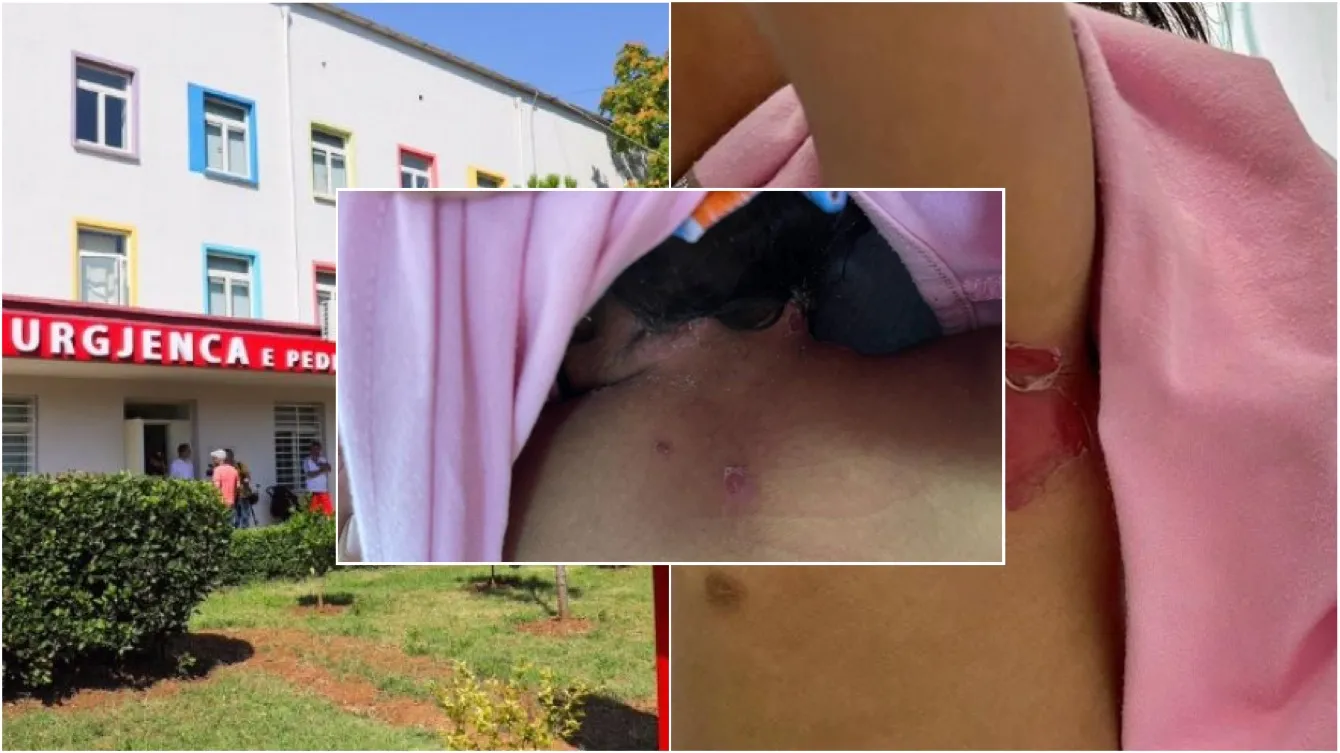 Dalin FOTOT e 2-vjeçares që  u dogj me cigare 1 javë para se të dërgohej për mjekim