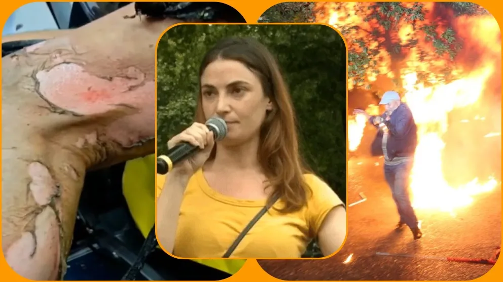 VIDEO/ Mori flakë pasi polici shtyu molotovin drejt turmës, aktorja nxjerr pamjet e plagëve të të atit: U sula t’ia shuaj, por u dogja edhe vetë!