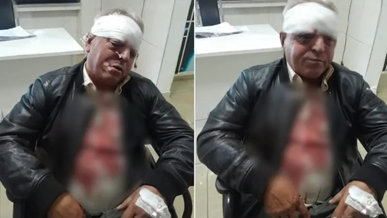 Dhunohet brutalisht punonjësi në Vlorë, rrezikon të humbë shikimin