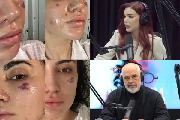 Kush është mjekja e promovuar nga Rama që i dogji fytyrën gazetares