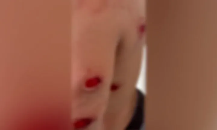 Pamje të rënda! Studenti me plagë në gjoks, krahë e shpinë nga plumbat e gomës