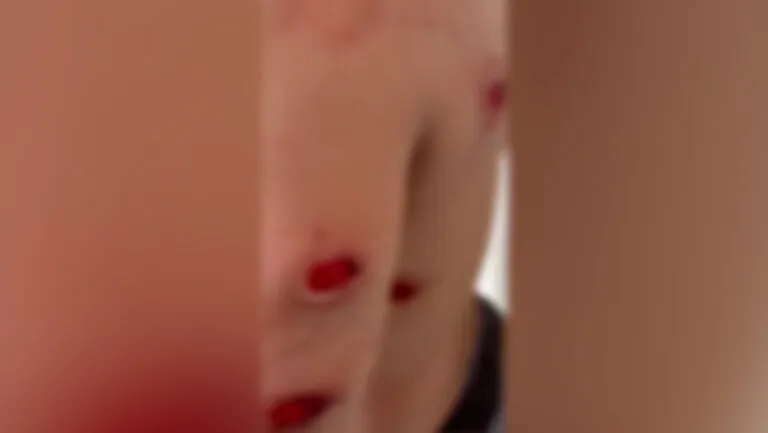 Pamje të rënda! Studenti me plagë në gjoks, krahë e shpinë nga plumbat e gomës