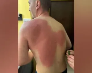 Revolta kombëtare, gazetari pëson djegie në trup: Njoftova ambulancën, thanë s’kemi çfarë të bëjmë