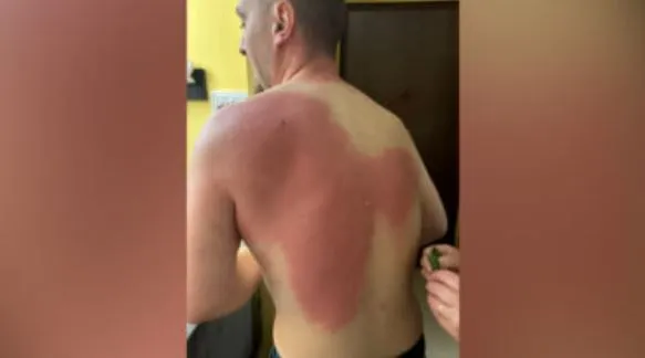 Revolta kombëtare, gazetari pëson djegie në trup: Njoftova ambulancën, thanë s’kemi çfarë të bëjmë