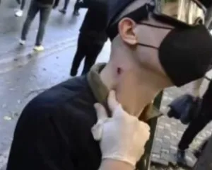 Plagoset në qafë gjatë protestës në Tiranë, i riu tregon shenjën në qafë